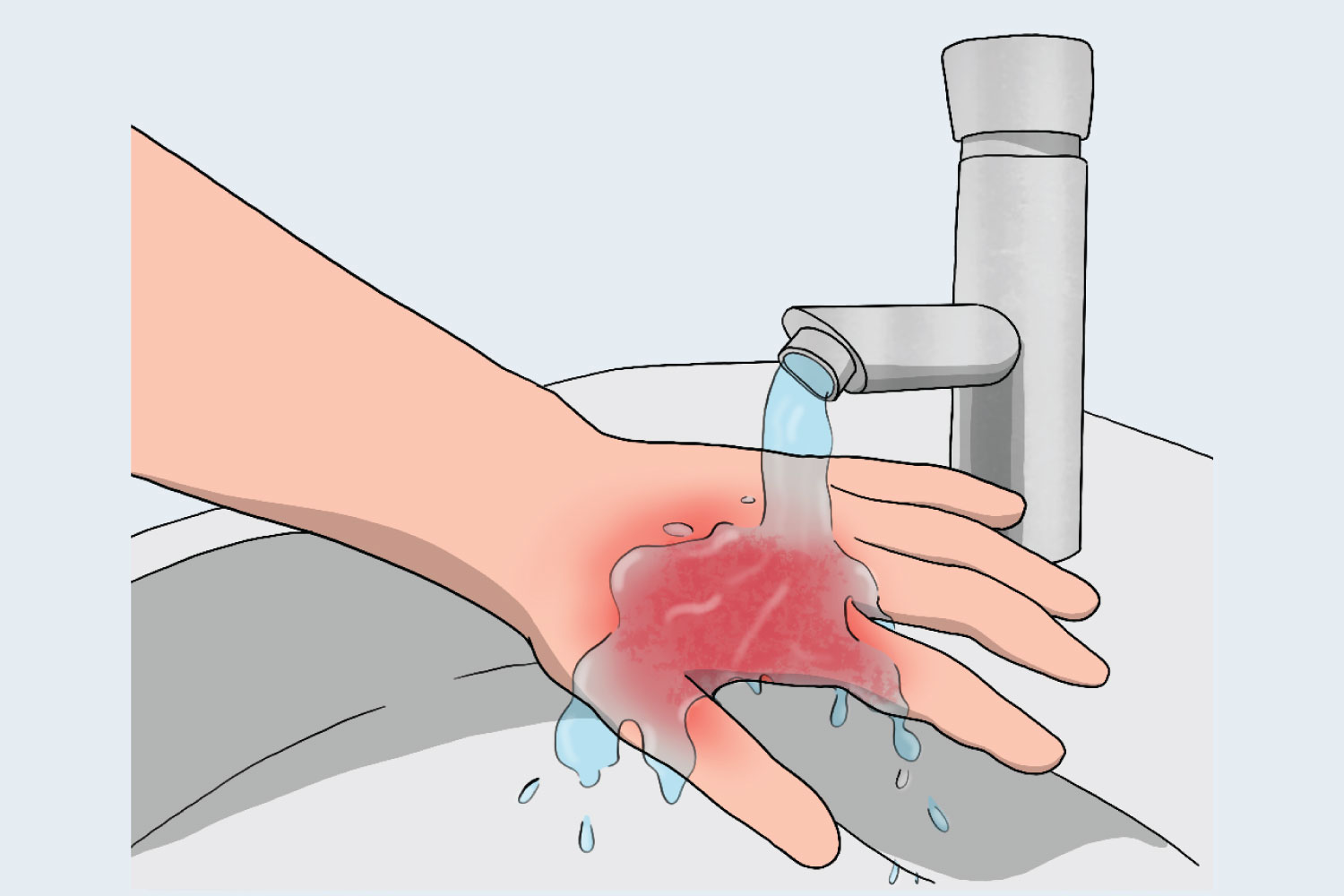 first aid for burn